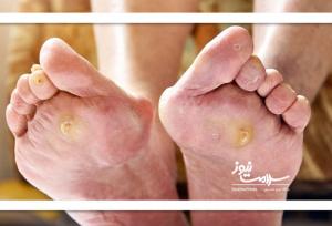راهکار مقابله با زخم پای دیابتی