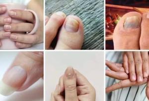 ۷ علامت هشداردهنده کلسترول بالا در ناخن کدامند؟