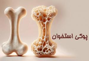 ۴۶ درصد عامل پوکی استخوان در ایلام کم‌تحرکی است