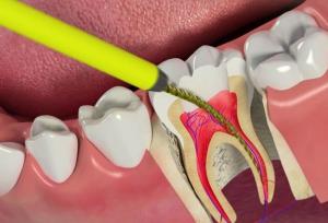 عمر دندان عصب کشی شده چقدر است ؟ | معرفی4 روش افزایش طول عمر