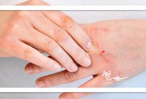روش‌های غیردارویی برای کنترل التهاب