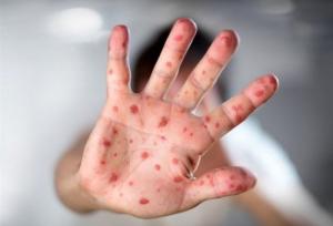 ابتلای ۴۲۲ نفر به سرخک در ۳ ماه اول سال/ شیوع بالاتر بیماری در ۲ استان