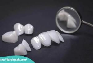 فرق لمینت و کامپوزیت کدام بهتر است؟