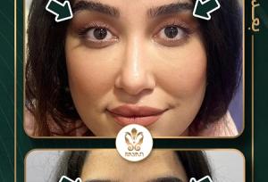 بلفاروپلاستی با لیزر