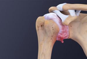 اهمیت بررسی ابتلا به بیماری های زمینه ای در سندروم شانه یخ زده