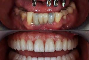 ایمپلنت کامل فک بالا و پایین (فول موس) چگونه انجام میشود؟