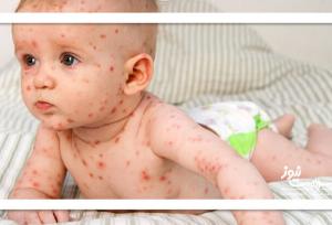 شایع‌ترین بثورات ویروسی در نوزادان
