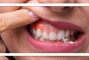 ورم لثه را جدی بگیرید