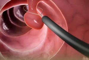 کولونوسکوپی چیست و چگونه انجام میشود؟