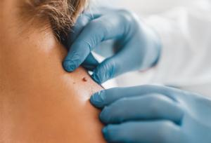 فریز کردن خال گوشتی چیست و چگونه انجام می شود؟