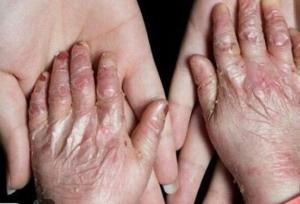 بیماری ای بی و ازدواج‌های فامیلی: ۹۵ درصد مبتلایان از ازدواج‌های فامیلی نتیجه می‌گیرند