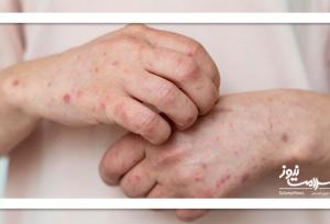 آلودگی هوا و تأثیر مخفی آن بر پوست: پیری زودرس و التهاب در کمین