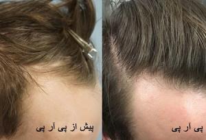 پی آر پی مو چیست و چگونه باعث درمان ریزش مو می شود؟