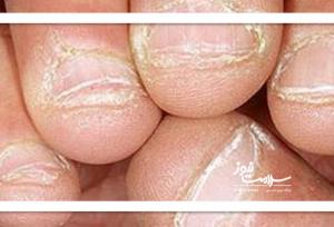 چرا دور ناخن پوسته پوسته می‌شود؟