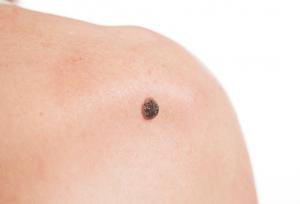 روش‌های از بین بردن خال و زائده‌های گوشتی