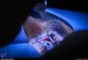 شیوع قوز قرنیه در ایران بالاتر از جهان/چه عواملی باعث بروز بیماری می‌شود؟