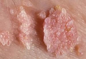 بهترین مرکز درمان زگیل تناسلی (ویروسhpv) در تهران + لیست ۱۰تایی