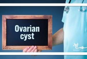 کیست تخمدان؛ شایع اما غالباً بی‌خطر در زنان بارور