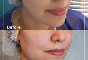 زاویه سازی صورت و فک | روش‌ها، مزایا، معایب و هزینه‌ها