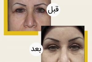 عمل جراحی پلک بالا و پایین (بلفاروپلاستی) چگونه است؟ + عکس