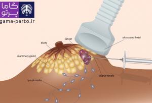 آیا سرطان سینه با سونوگرافی قابل مشاهده است؟