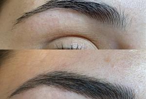 بهترین مرکز فیبروز ابرو کجاست؟