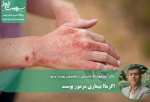 اگزما؛ بیماری مرموز پوست