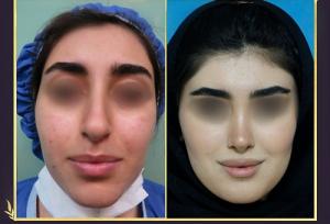 عمل جراحی بینی سربالا + ترمیم بینی خوکی