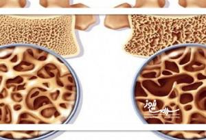 آلو خشک؛ راهی طبیعی برای تقویت استخوان‌ها و کاهش خطر پوکی استخوان در زنان یائسه