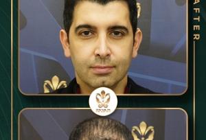 انقلاب لیزری در کاشت مو؛ حقیقتی تازه یا دروغ تبلیغاتی؟!