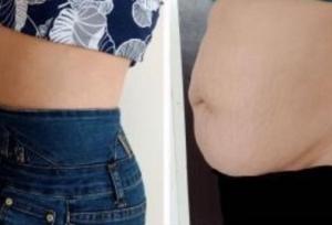 پیکرتراشی ارزان | هزینه انواع روش (لیپوماتیک و...) در سال ۱۴۰۴