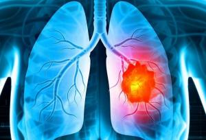 درمان تغییرات ایجادشده در میکروبیوم ریه بر اثر سیگار کشیدن