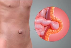 آیا می‌توان فتق را بدون بیهوشی درمان کرد؟ بررسی راهکارهای موجود