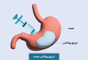 بوتاکس معده چیست و چطور باعث لاغری می شود(مزایا+عوارض)