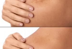 مقایسه درمان جای زخم با سلول‌های بنیادی و لیزر؛ کدام مؤثرتر است؟