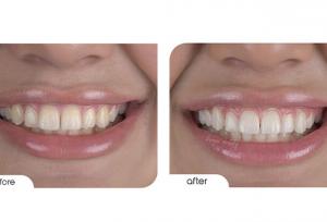 بلیچینگ با لیزر ؛ روشی نوین برای سفید کردن دندان ها