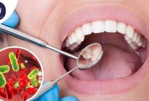 آیا ممکن است عفونت ریشه دندان پس از عصب‌کشی برگردد؟