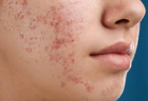 درمان جدید آکنه از راه رسید
