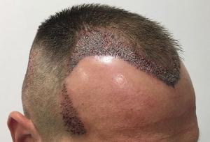 بهترین کلینیک‌های کاشت مو در تهران + معرفی ۱۰ کلینیک برتر