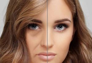 تزریق چربی به صورت | مراحل، مزایا و عوارض