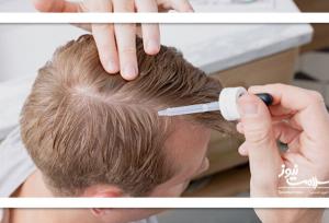 پروکاپیل در مقابل ماینوکسیدیل: کدام برای ریزش مو بهتر است؟