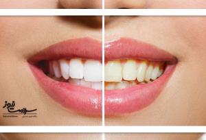 ۷ دلیل مهم برای زرد شدن دندان‌ها