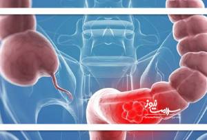 سرطانی که با تغییر اجابت مزاج خود را نشان می‌دهد