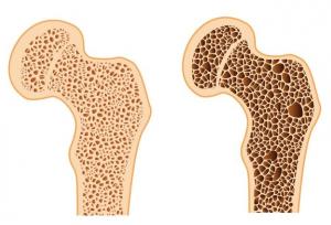 ارتباط تغذیه و پوکی استخوان