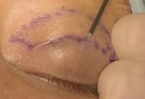 استادیار دانشگاه علوم‌پزشکی اصفهان:بلفاروپلاستی ظاهر چشم را تغییر نمی‌دهد؛ فقط جوان‌تر می‌کند