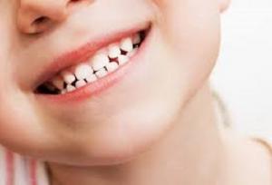 قطره آهن دندان را سیاه می کند؛ گول نخورید