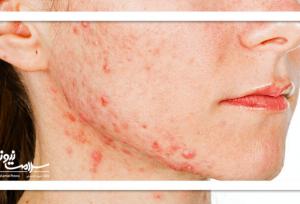 ۷ نشانه مهم که می‌گوید PCOS شما در حال بدتر شدن است