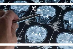 نشانه‌هایی که خبر از سرطان مغز می‌دهند