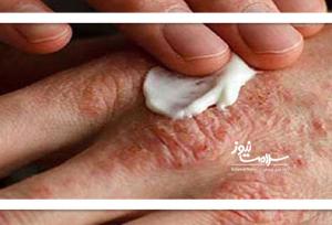 بلایی که خشکی بدن زمستان بر سر بدن می‌آورد