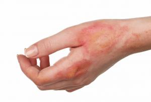 ترمیم جای زخم قدیمی با سلول بنیادی چگونه انجام می‌شود؟ + مزایا و کارکرد